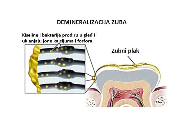 Demineralizacija zuba