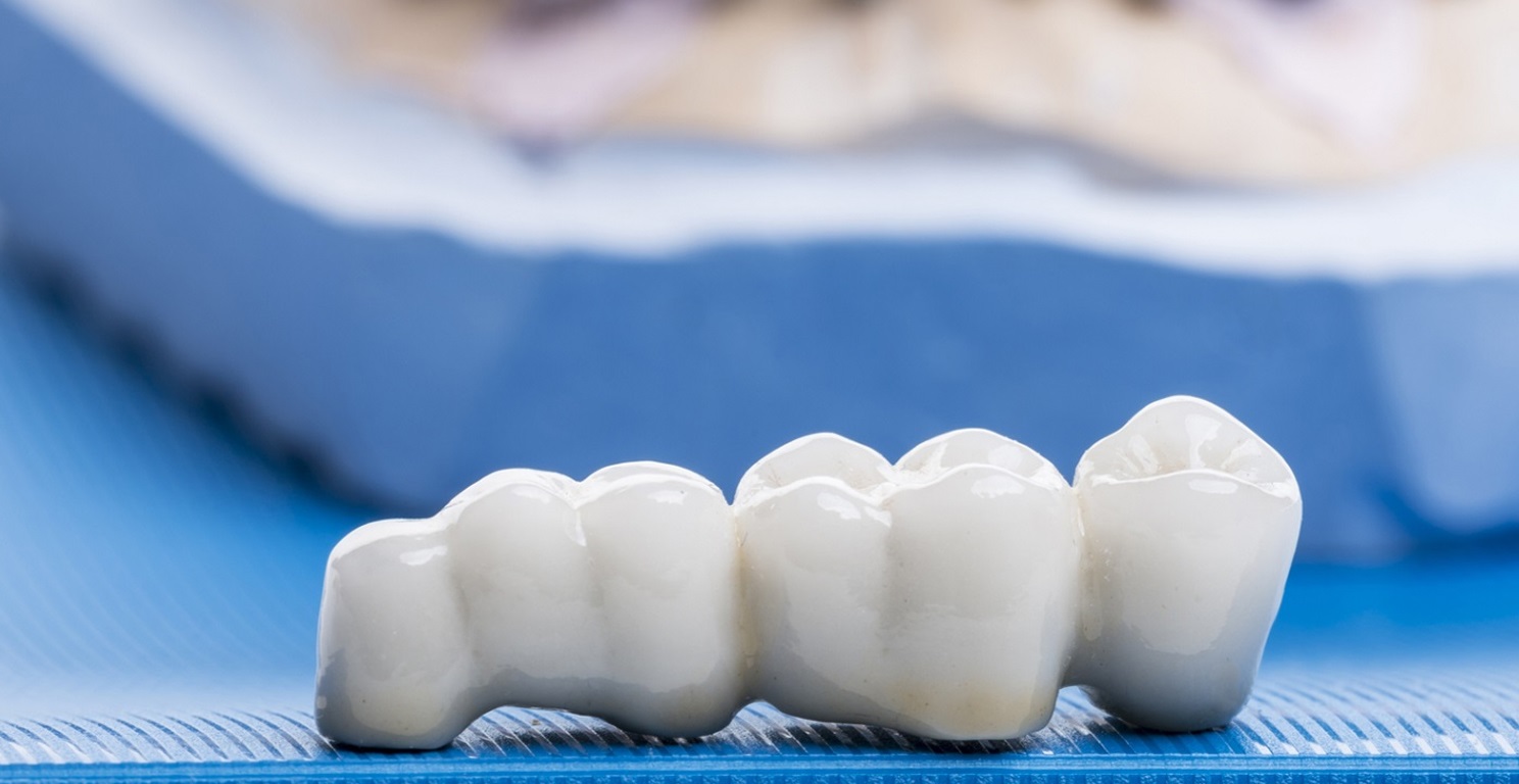 Dentalne nadoknade koje se mogu izbeliti