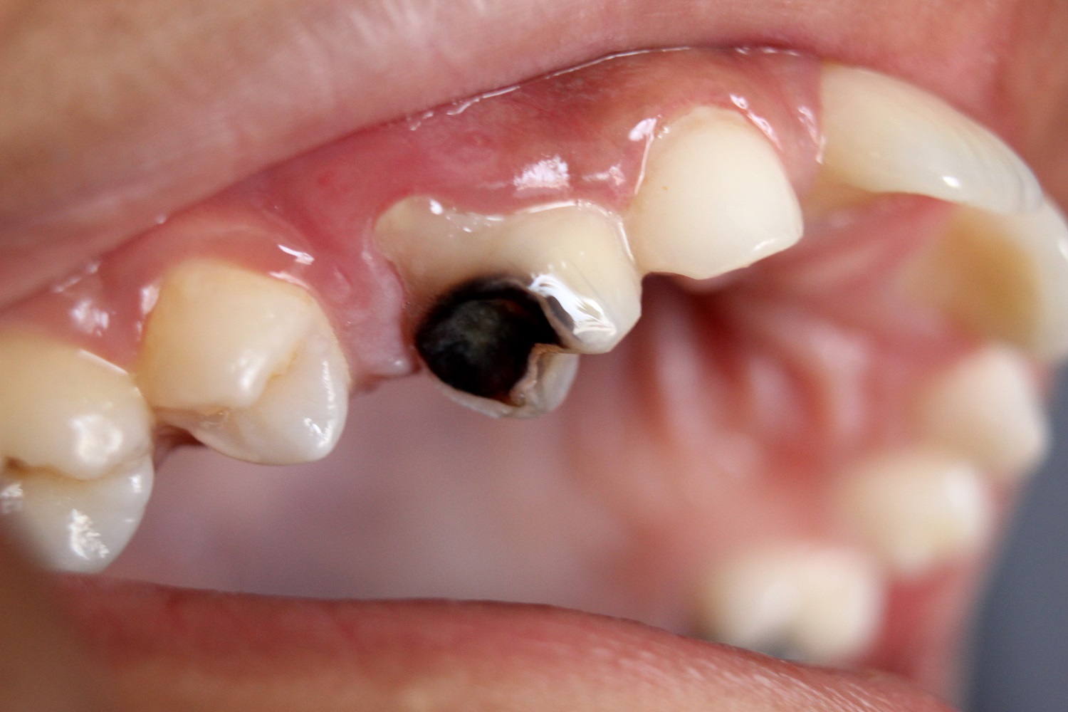 Oštećenje zuba izazvano karijesom