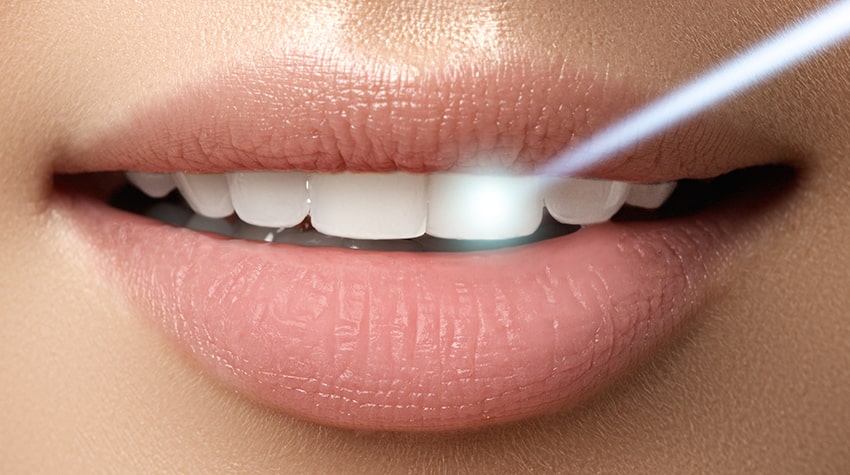 Lasersko Izbeljivanje zuba koristi Usmereni laserski zrak na zube