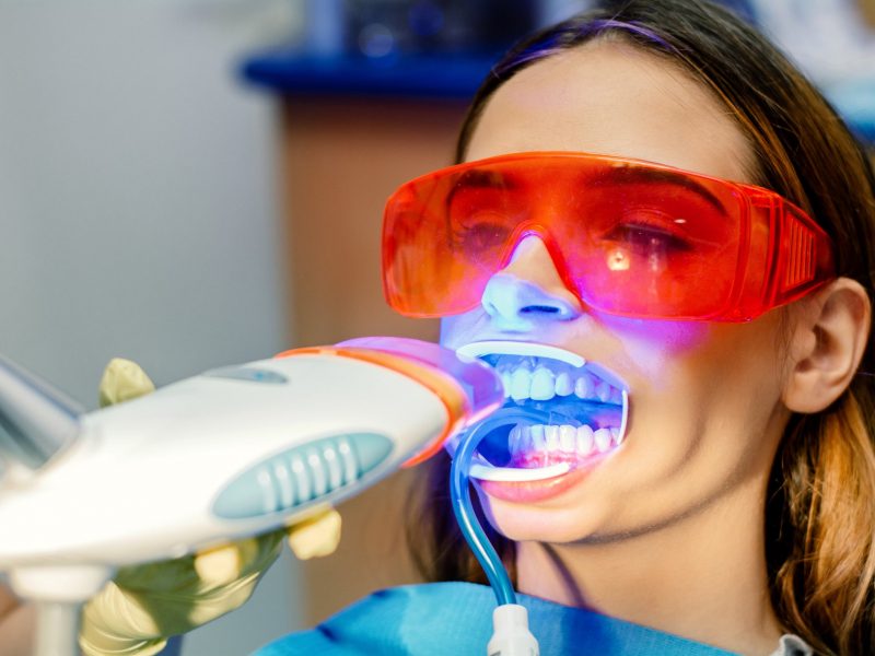 White Smile metoda za izbeljivanje zuba