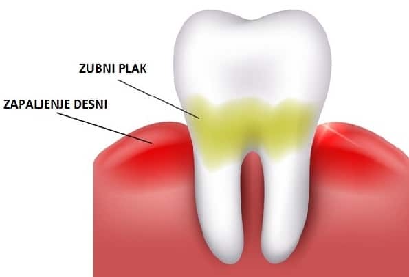 Zubni plak uzrokuje karijes