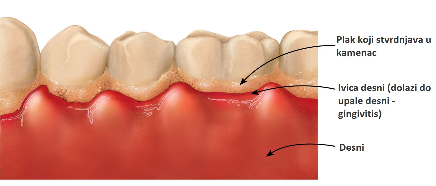 Formiranje plaka i kamenac na zubima
