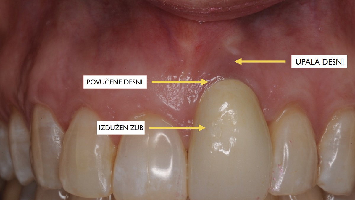 Povlacenje desni sa zuba