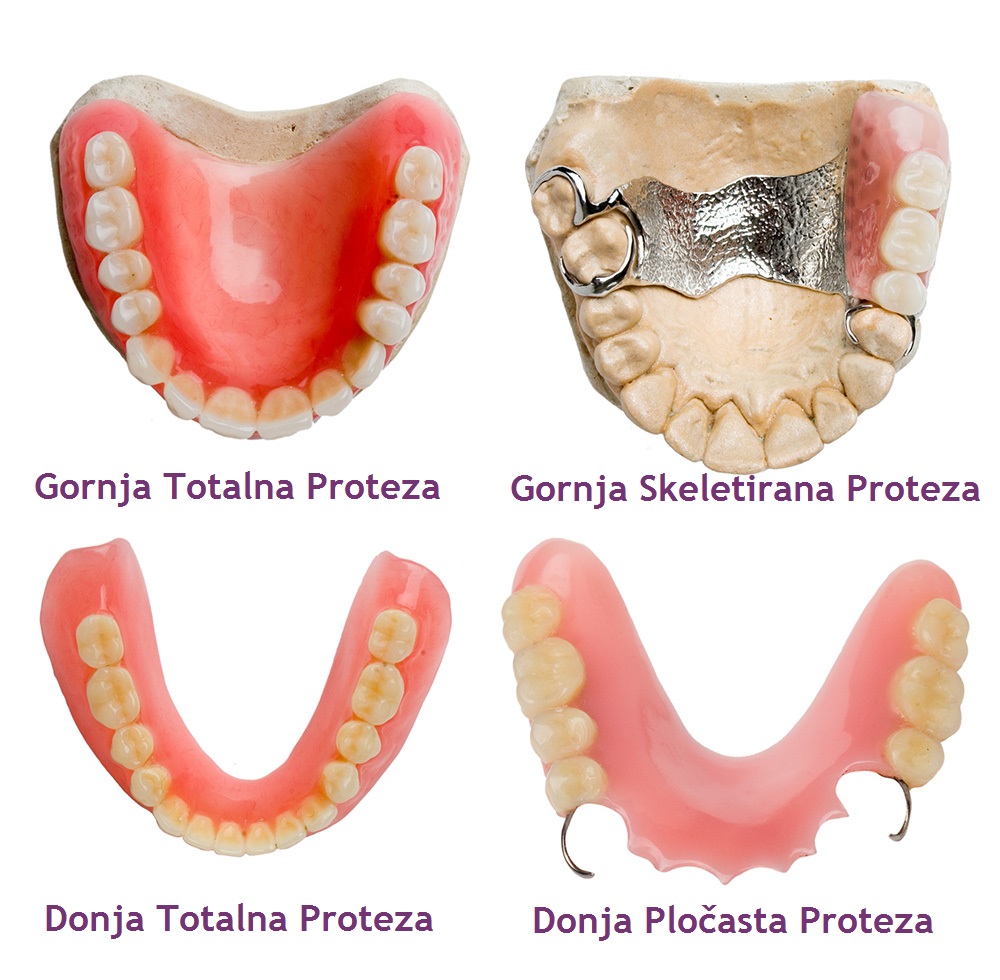 Proteza za zube vrste