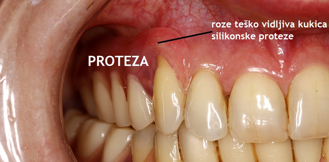 valplast proteza za zube