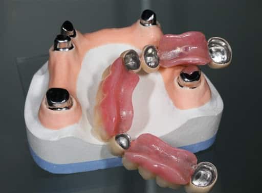zubna proteza na teleskopima