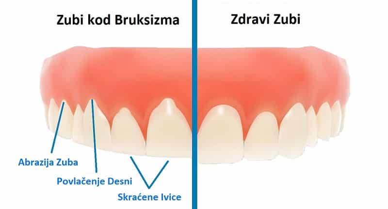 Trošenje i Abrazija zuba kod Bruksizma