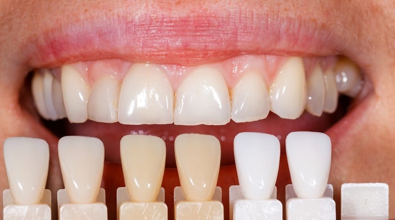 Fasete na zubima i promena boje