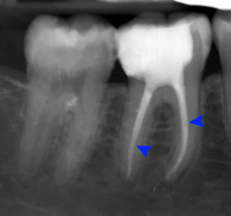 bol u zubu nakon vadjenja zivca - infekcija na vrhu korena zuba