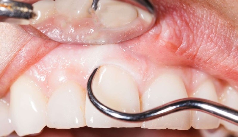 apikotomija oporavak nakon resekcije korena zuba