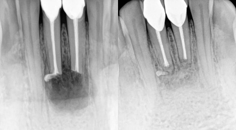 resekcija korena zuba pre i posle