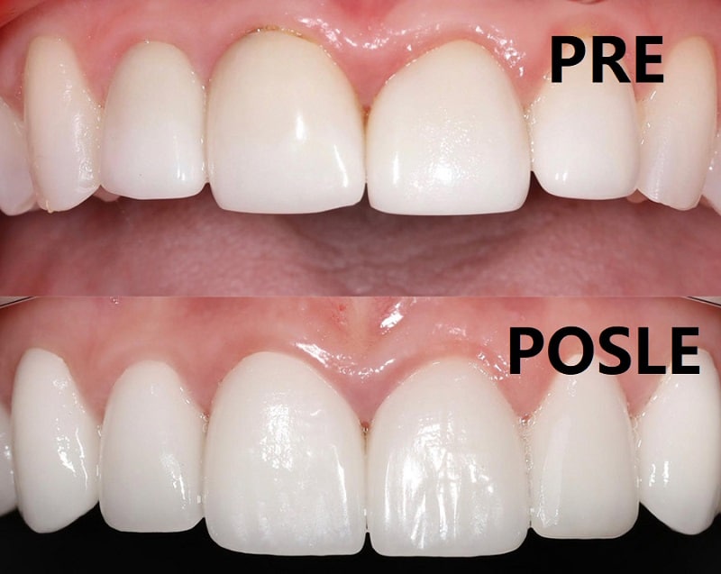 ispravljanje zuba navlakama - fasetama i krunicama