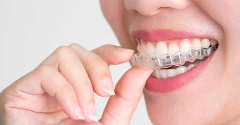 providna proteza za ispravljanje zuba